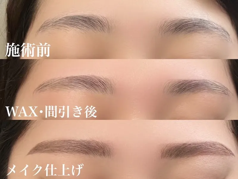 施術写真
